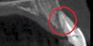 2ac9601a Implantes dentário antes e depois