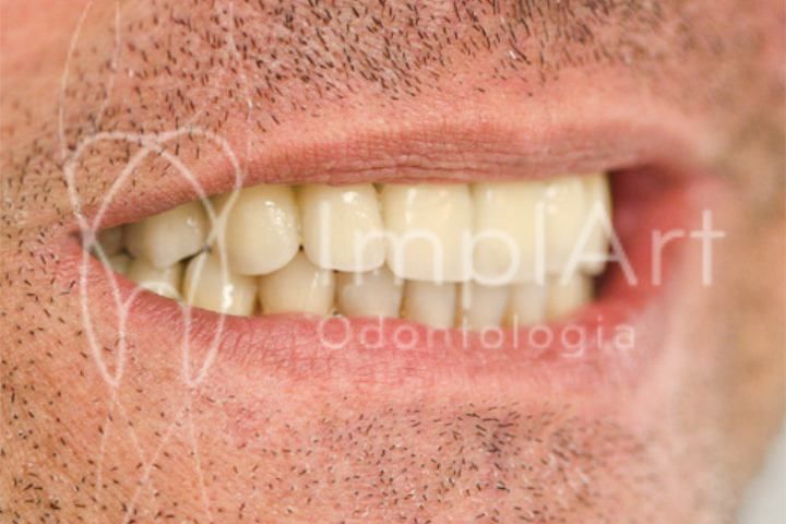 carga_imediata_implante_total_49kb-2b63bed3 Quanto custa um implante com carga imediata