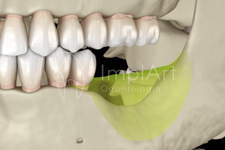 2c4de4ed Carga imediata: qual a diferença para um tratamento normal