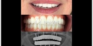 2caedfb0 Qual Cor dos Dentes é Ideal para Lentes e Coroas de Porcelana ?