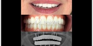 protese_total_zirconia_translucida_monolitica_40kb-2caedfb0 Prótese dentária temporária de transição para implante completo