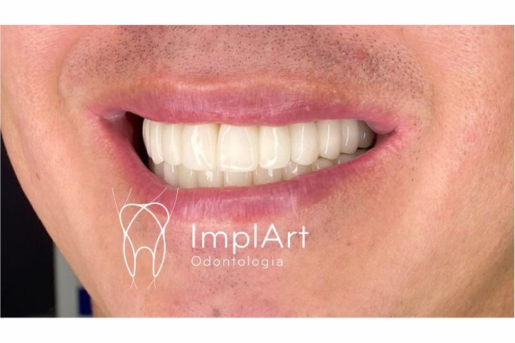 2d1bde9c Cirurgia de implante guiada (fechada) ou cirurgia aberta