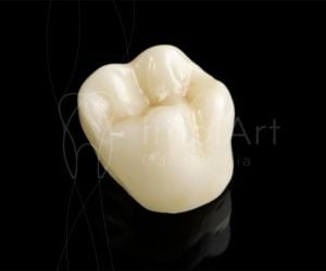 coroa_zirconia_estetica_cerec_50kb-2e022c6a Enxerto ósseo biomolecular para implante