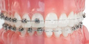 3261f1b2 Prótese protocolo | Gengiva caracterizada e dentes importados