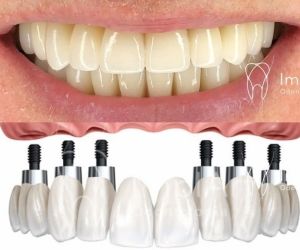 all-on-6-32abb5db Complicações / erros e falhas em implantes dentários