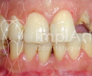 35b9ef0e Por que trocar sua prótese fixa sobre dentes por implante com coroa?