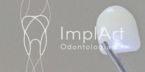 35d91d66 Implante total dos dentes superiores