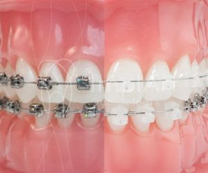 39af1929 Prótese protocolo de resina com estrutura de titânio