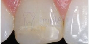 resina_manchada-3a4dfe02 O que é Reabertura do Implante Dentário: Entenda o Procedimento