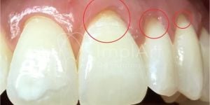 retracao_gengival_49kb-3a27a02b Dentes de tubarão: imagens divulgadas na internet como lentes dentais, mas não são.