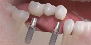 ponte_fixa_sobre_implantes_50kb-3b39e8b9 Desvendando os Mitos sobre Implantes em Idosos