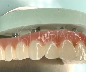 3cce9c4f Implantes dentários: alimentação e cuidados após a cirurgia