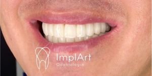 zirconia-sorriso-close-3de346d0 Nico lesões intra ósseas, o que são e tratamento