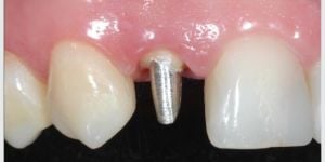 3e2ca999 Por que trocar sua prótese fixa sobre dentes por implante com coroa?