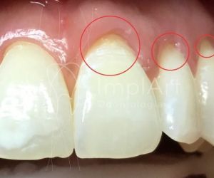 3ebdfa65 Epilepsia e a Odontologia: tratamento dental e implante dentário