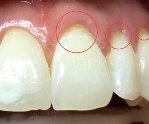 retracao_gengival_49kb-3ebdfa65 Irrigador dental é um aliado da boa higiene oral para implantes