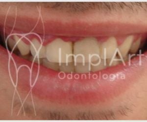 3fcb59e7 Complicações / erros e falhas em implantes dentários