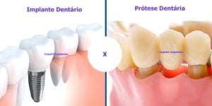 implante-ou-protese-dentaria-qual-e-melhor-3f0d5449 O que é zircônia dental? E porque é o melhor material ?