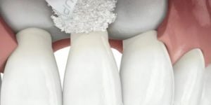 40183235 Indicações para a prótese dentaria adesiva