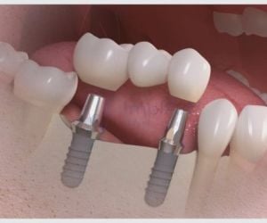 4079b3a1 Enxerto ósseo com plasma rico em fibrina