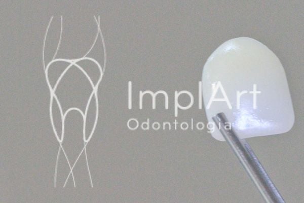 413d2390 Lentes de contato dental para correção de diastema