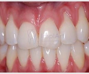 424d0215 Qual a diferença entre pivô, coroa e jaqueta?