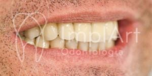 42bef9f9 Prótese dentária de porcelana ou de resina?