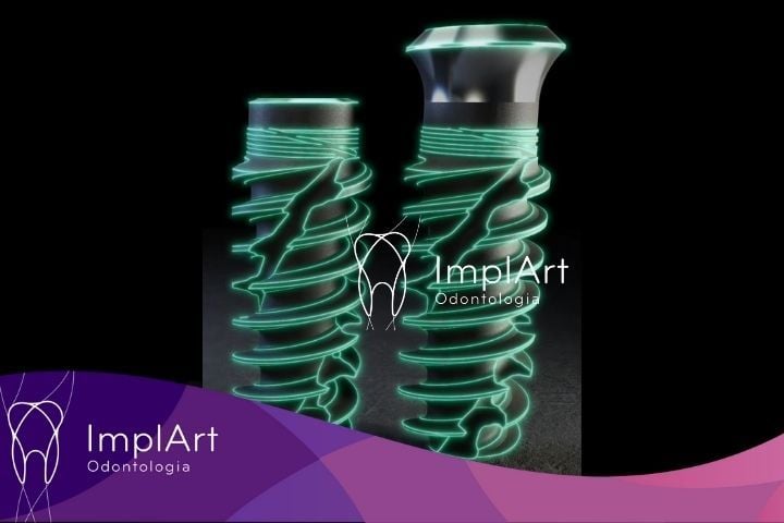 4554a7d9 Novo Implante Straumann iEXCEL: implante rápido com osseointegração em 21 dias