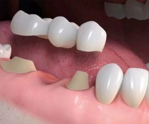 ponte_fixa_sobre_dente_50kb-480638c2 Implante dentário em quem usa aparelho ortodôntico