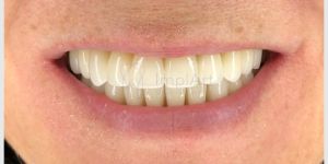 4c21ee14 Prótese flexível removível sem grampos - flex