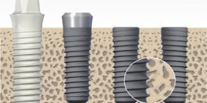 4d1e261e Carga imediata com 4 implantes para prótese protocolo