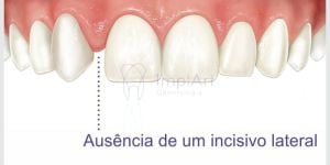 4df36919 Agenesia dentária e a necessidade de implantes