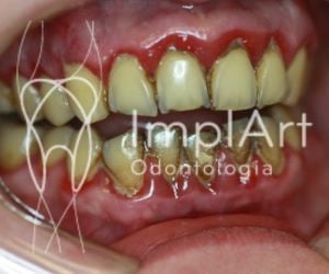 4e9931b8 Epilepsia e a Odontologia: tratamento dental e implante dentário