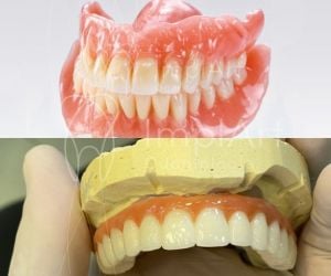 protese_movel_dentadura_x_protese_implante_50kb-4e3749c9 ImplArt - Spa odontológico - Clínica de implantes dentários e estética dental