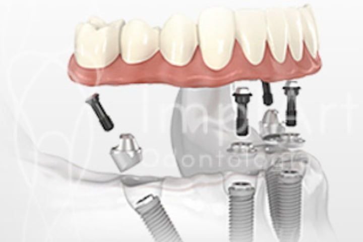 4f7afa8c Carga imediata com 4 implantes para prótese protocolo