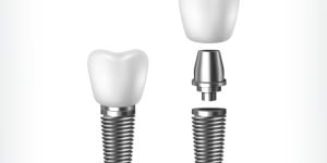 4feedafa O que devo saber sobre os Tipos de implantes dentários?