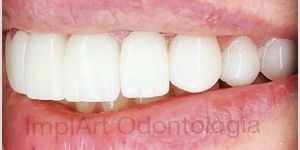 50a70f53 Implante dental - 4 coisas que você precisa saber antes de fazer o seu