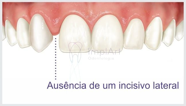 5208ddce Agenesia: dentes que não nasceram podem ser supridos com implantes?