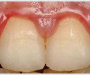 535a18d4 Rejeição de implante dentário: pode ocorrer?