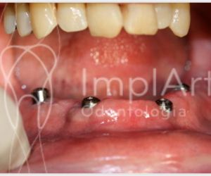 557d26f2 Enxerto ósseo biomolecular para implante