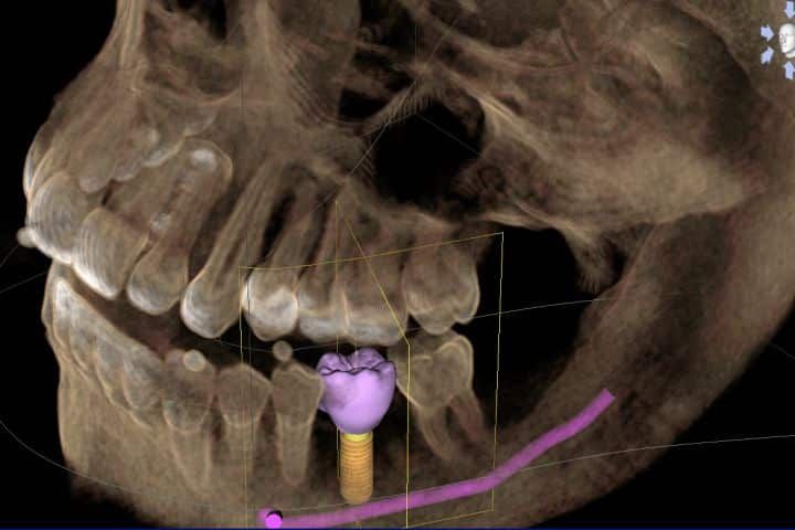 tomografia_radiologia_digital_50kb-56837a35 ImplArt oferece Tomografia Computadorizada 3D dentro da clínica