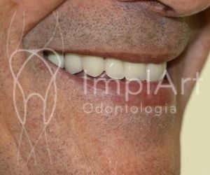 58135476 Implante de Três Dentes Juntos - Como fazer ?