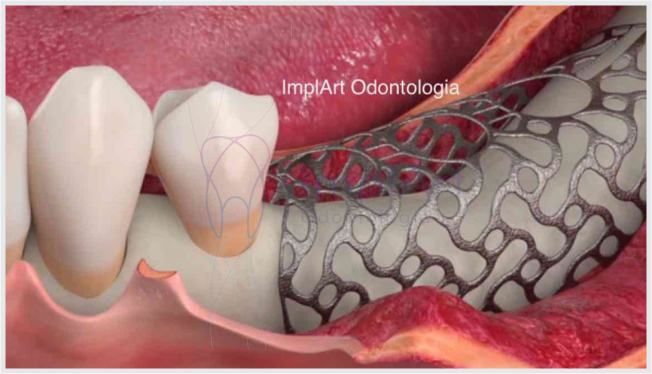 58ca5993 Reabilitação oral com coroas de porcelana individuais