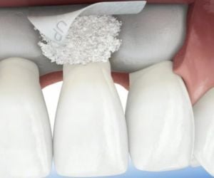 59fbfe10 All on 4 Implants in Brazil: affordable Smiles
