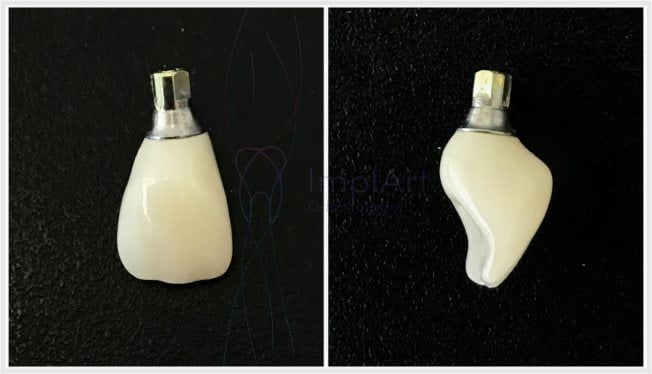 5a1f8464 Extração de dente: indicações e cuidados