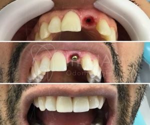 5b852a86 Rejeição de implante dentário: pode ocorrer?