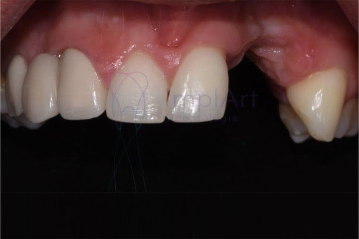5e4e799e Restaurando Sorrisos com Precisão: Implante Dentário Parcial na Clínica ImplArt