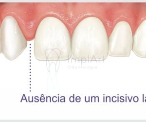 603221ec Quantos implantes dentários são colocados de cada vez?