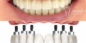 6296bab0 Implante dentário - perguntas ao especialista - entrevista