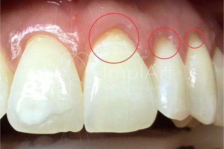 63ed727e Irrigador dental é um aliado da boa higiene oral para implantes